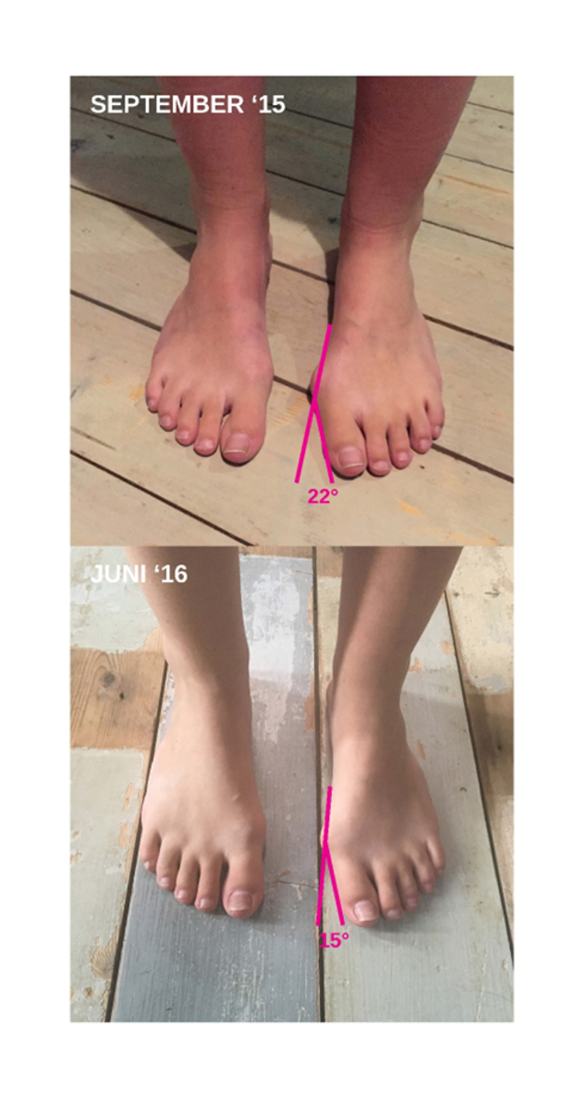 STEP-FLEX Die Besten Einlagen auf dem Markt